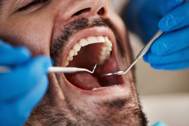 Best Emergency Treatment for Dental Infections or Abscesses in Depew, NY